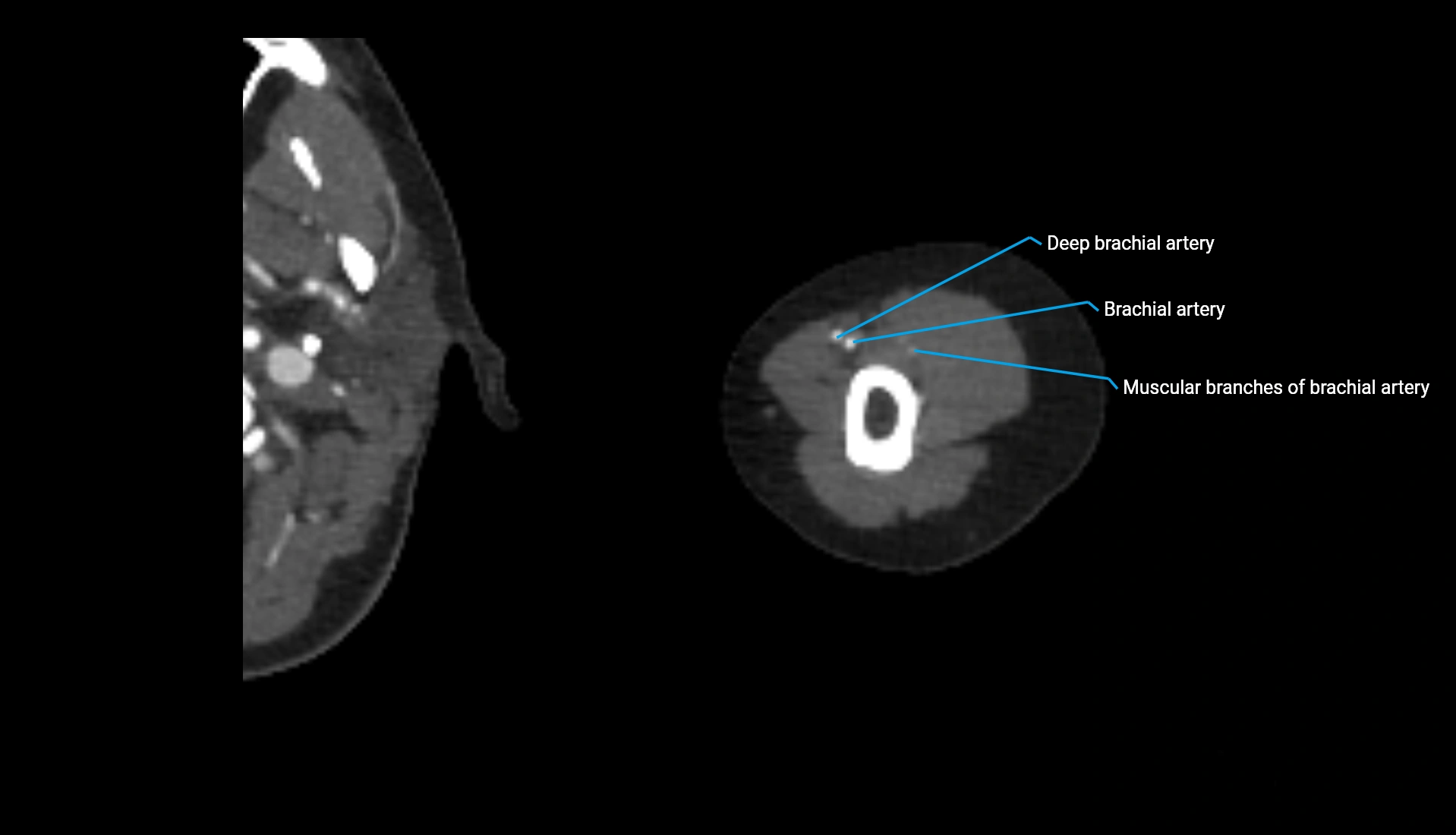CTA upper limb axial cross sectional anatomy labelled image 273 (2).webp